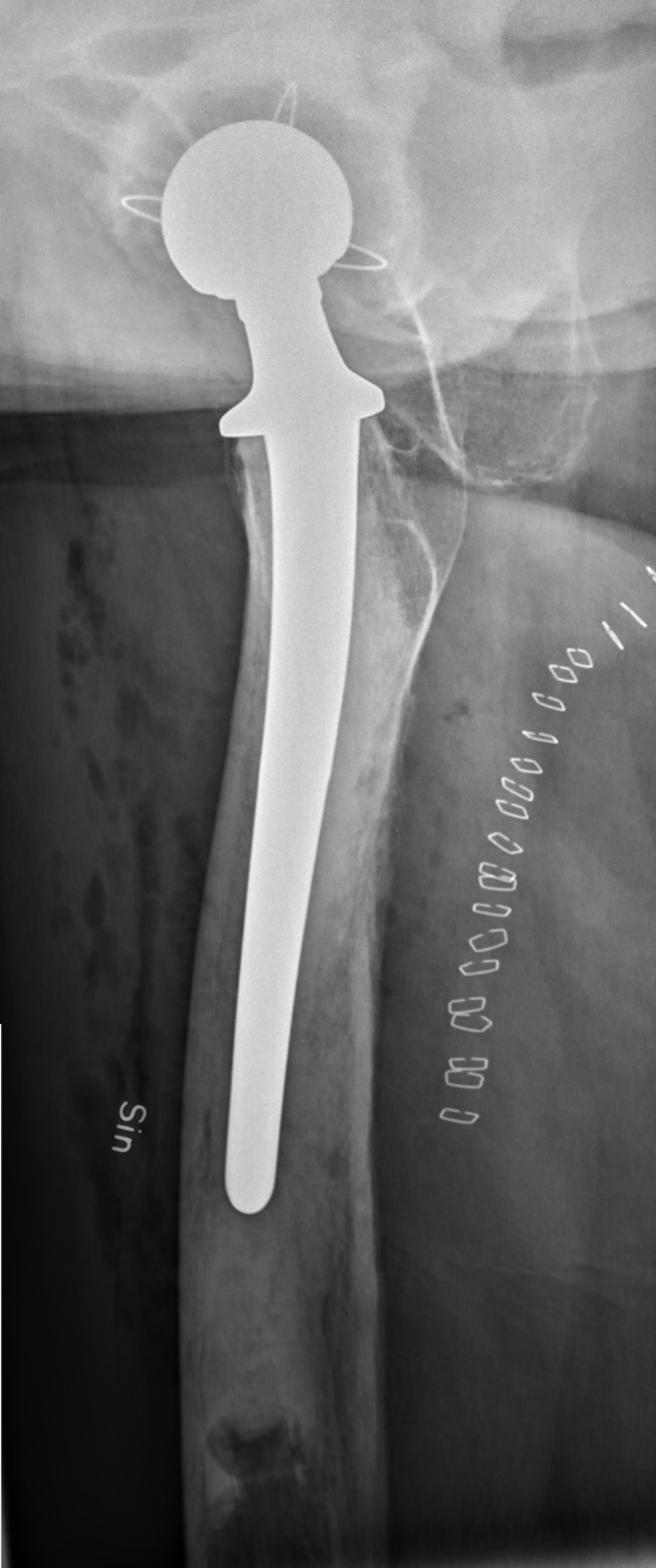 Röntgenbild einer Hüfte mit einem sichtbaren Bruch in der Mitte, mit detaillierter Abbildung zur Diagnose und Behandlungplanung.